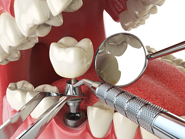 Best Chipped Tooth Repair Near Me  in Ruckersville, VA